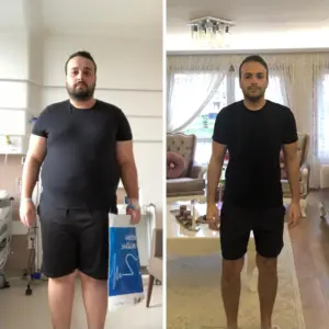 obezite cerrahisi deegisim sanati1