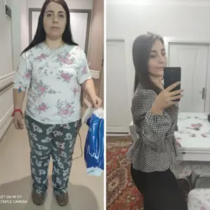 obezite cerrahisi deegisim sanati3