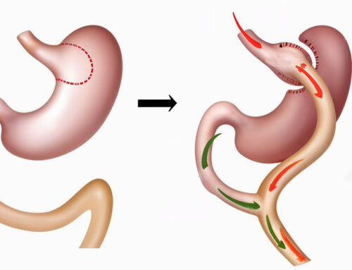 Roux-en-Y Gastric Bypass surgery (RYGB)