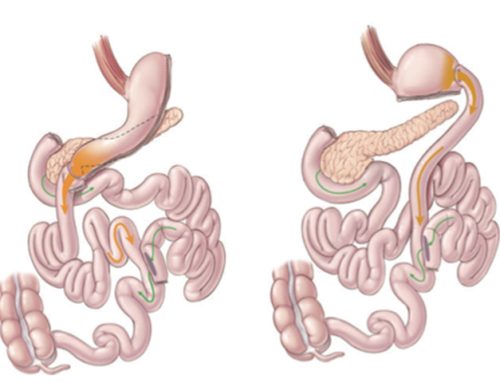 Biliopankreatik Diversiyon & Duedenal Switch