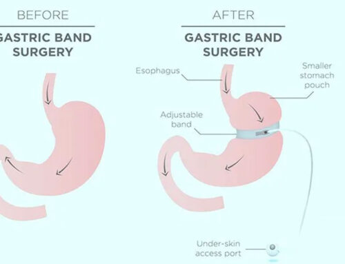 Gastric Band (Lap Band) Surgery