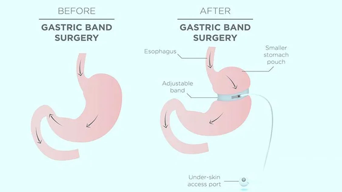 Gastric Band (Lap Band) Surgery 4 gastric band lap band surgery turkey