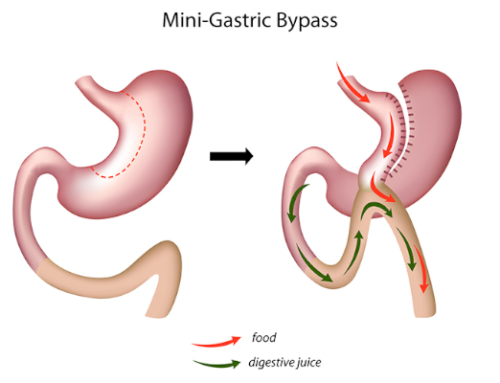 Mini Gastrik Bypass